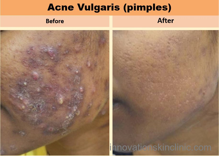 Acne Vulgaris Pimples 4